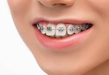 Tratamiento de Brackets en Expert Dental - Clínica de Especialidades Dentales en CDMX y Chilpancingo