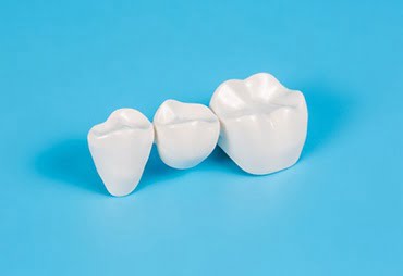 Tratamiento de Coronas Dentales en Expert Dental - Clínica de Especialidades Dentales en CDMX y Chilpancingo