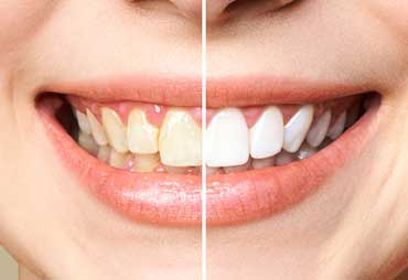 Tratamiento de Blanqueamiento en Expert Dental - Clínica de Especialidades Dentales en CDMX y Chilpancingo