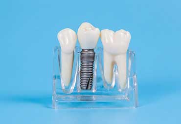 Tratamiento de Implantes Dentales en Expert Dental - Clínica de Especialidades Dentales en CDMX y Chilpancingo