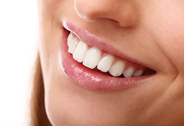Tratamiento de Resinas Dentales en Expert Dental - Clínica de Especialidades Dentales en CDMX y Chilpancingo